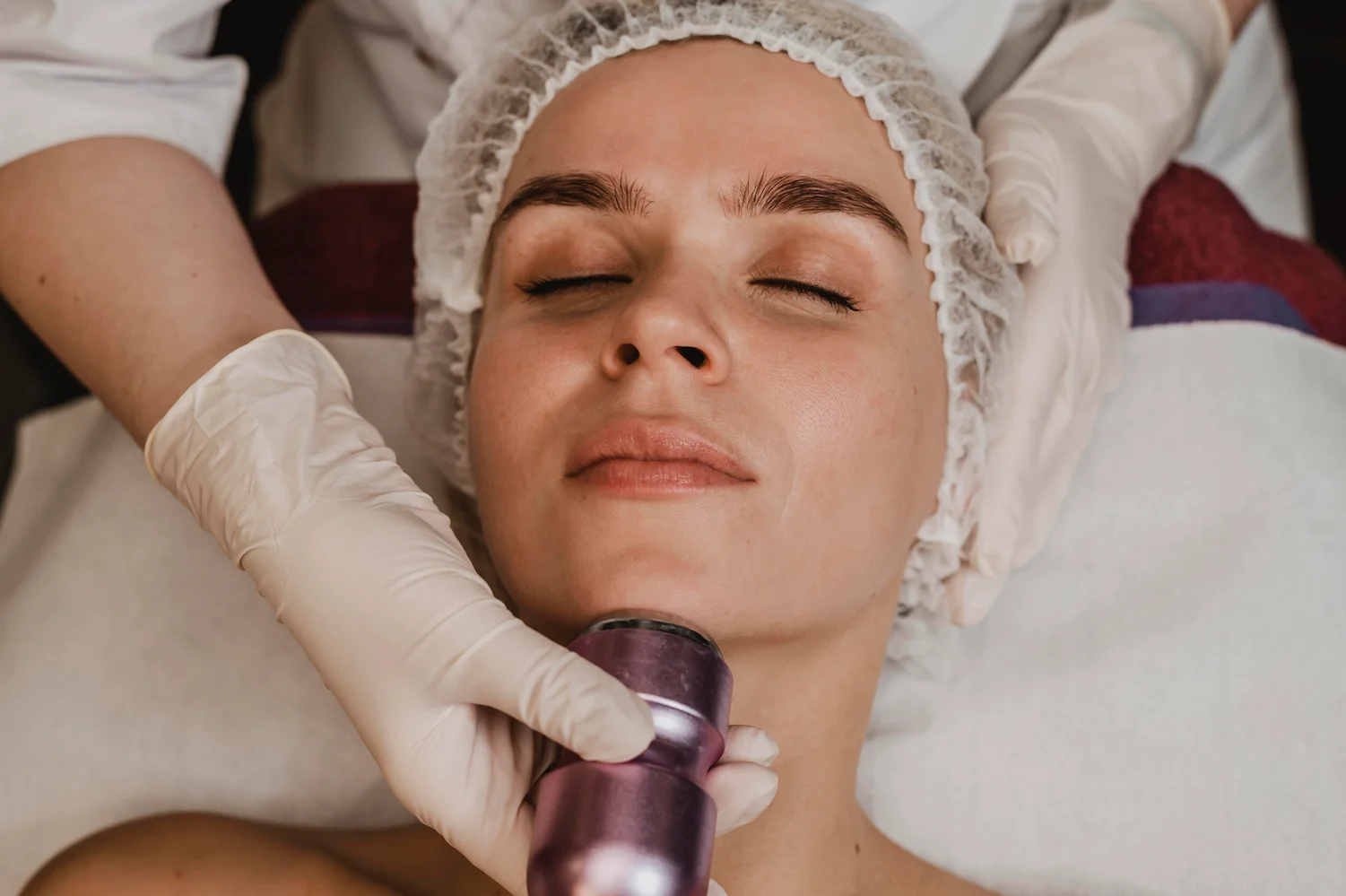 Alma Hybrid CO2 laser for skin tightening in Orange County