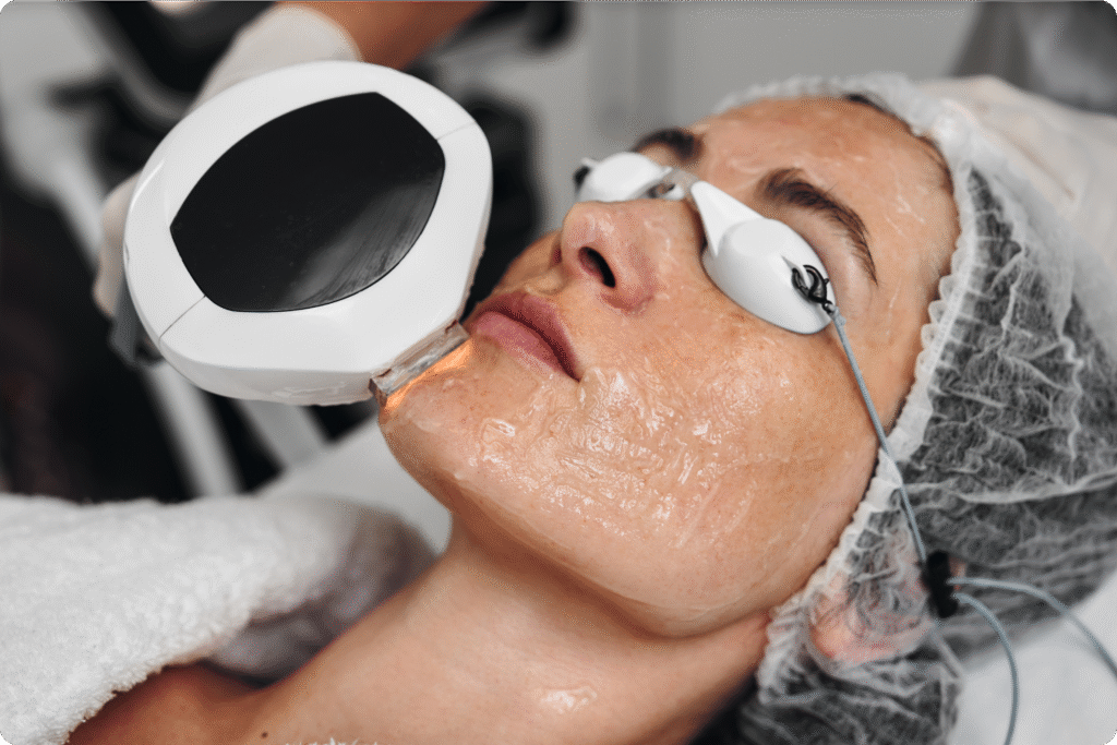 Dye-VL IPL Treatment