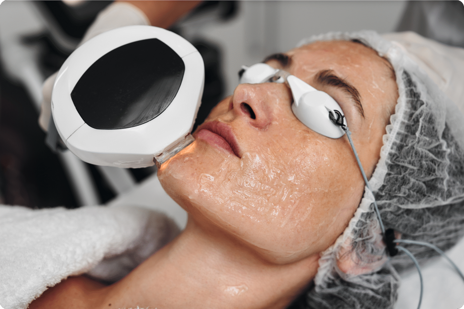 Dye-VL IPL Treatment